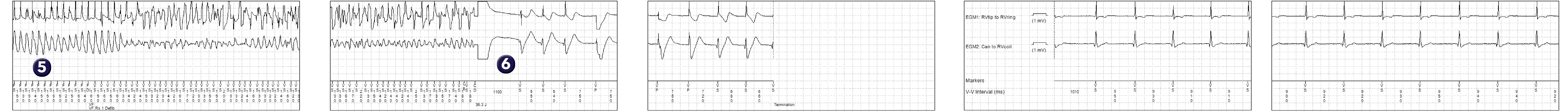 Medtronic ICD electrogram, segment 1 of 2 — Single-chamber defibrillator and SVT V. Limit