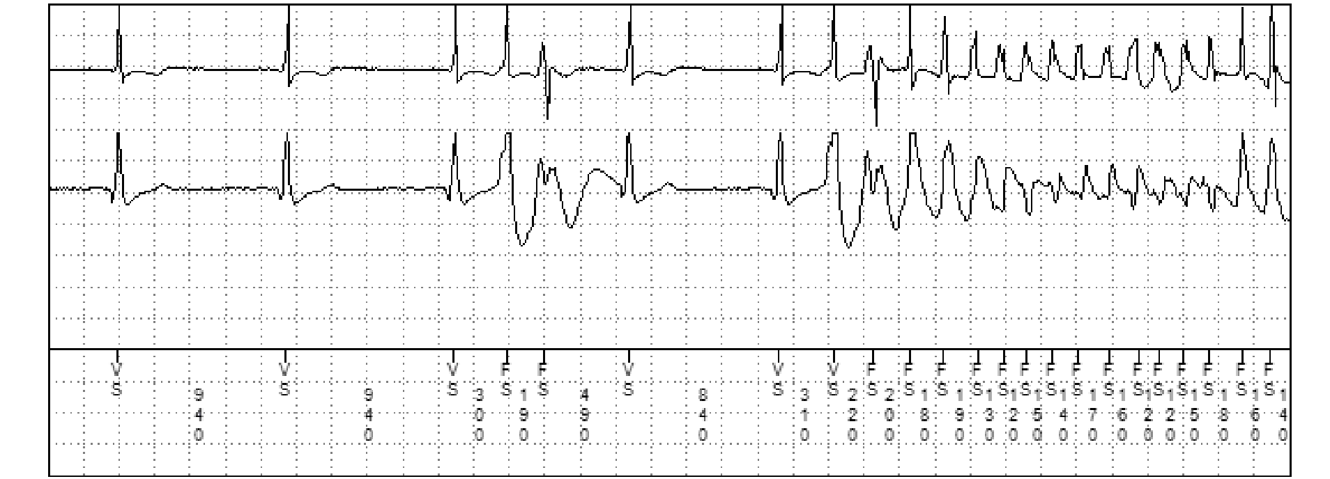 Medtronic ICD electrogram, segment 2 of 2 — Single-chamber defibrillator and SVT V. Limit