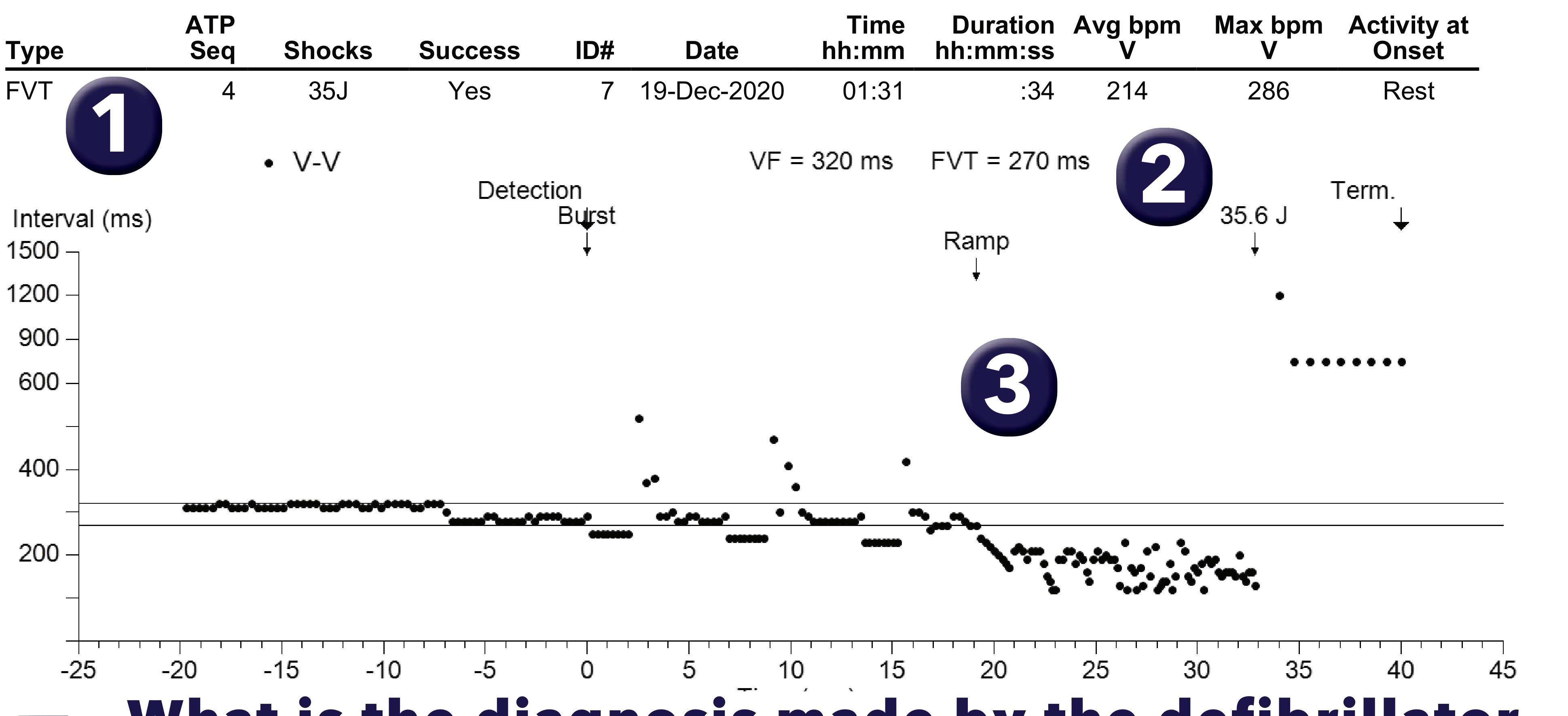 Medtronic ICD electrogram, segment 1 of 1 — Limitations of discrimination based on Wavelet
