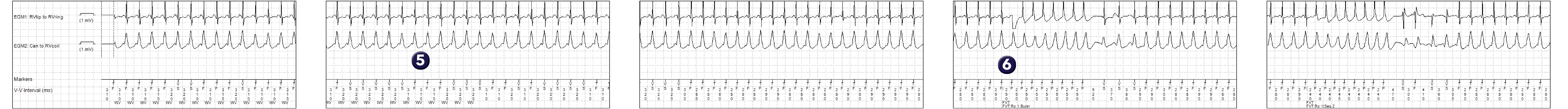 Medtronic ICD electrogram, segment 1 of 2 — Limitations of discrimination based on Wavelet