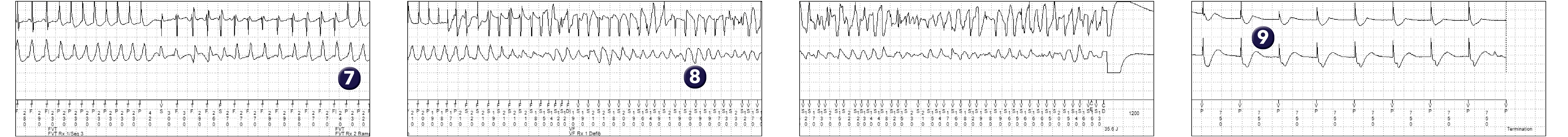 Medtronic ICD electrogram, segment 2 of 2 — Limitations of discrimination based on Wavelet