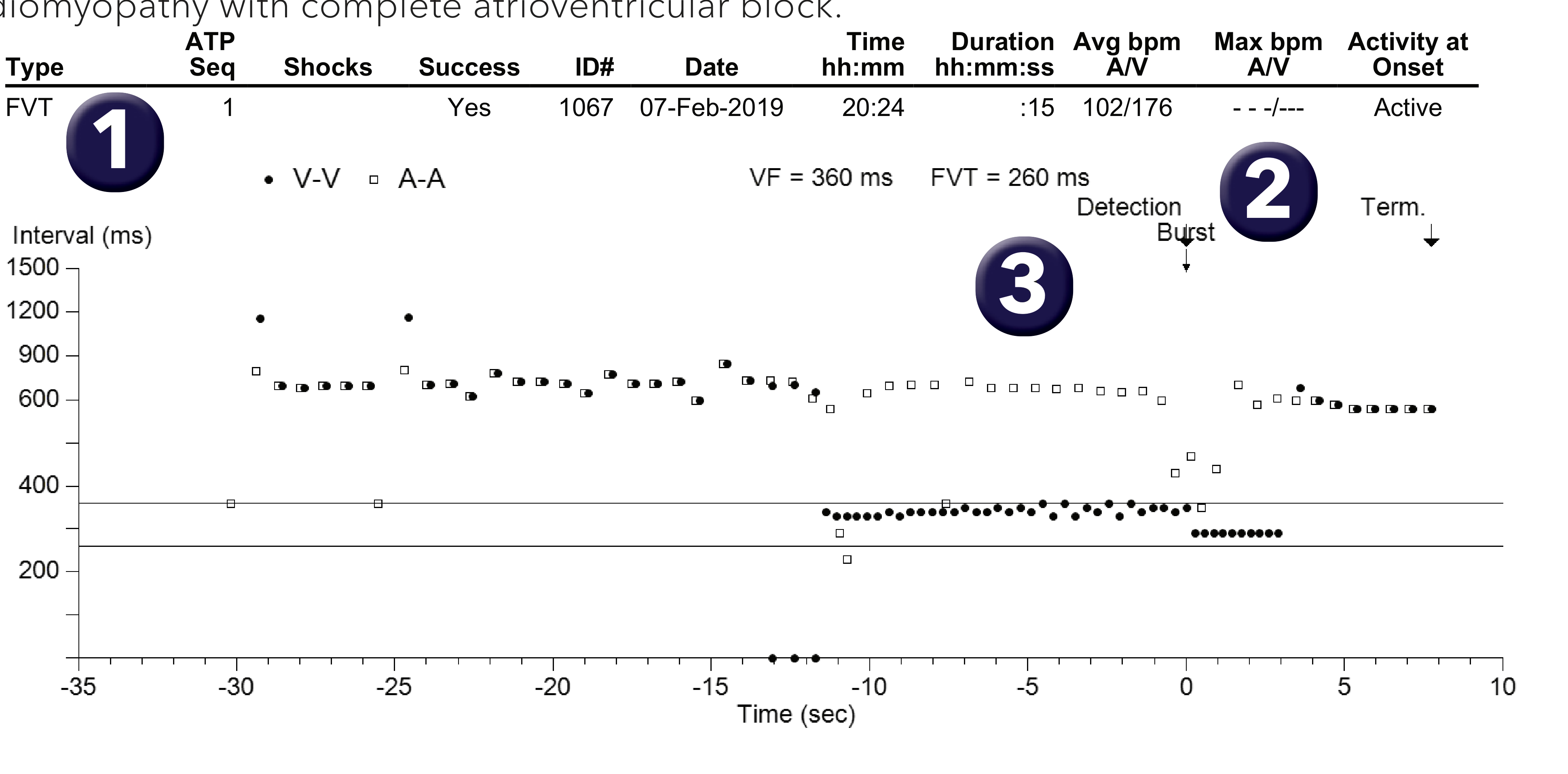 Medtronic ICD electrogram, segment 1 of 1 — Discrimination and atrioventricular conduction disorders