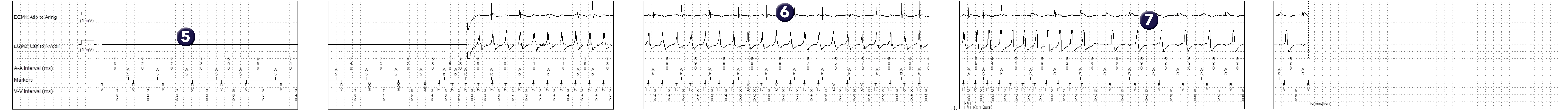 Medtronic ICD electrogram, segment 1 of 1 — Discrimination and atrioventricular conduction disorders