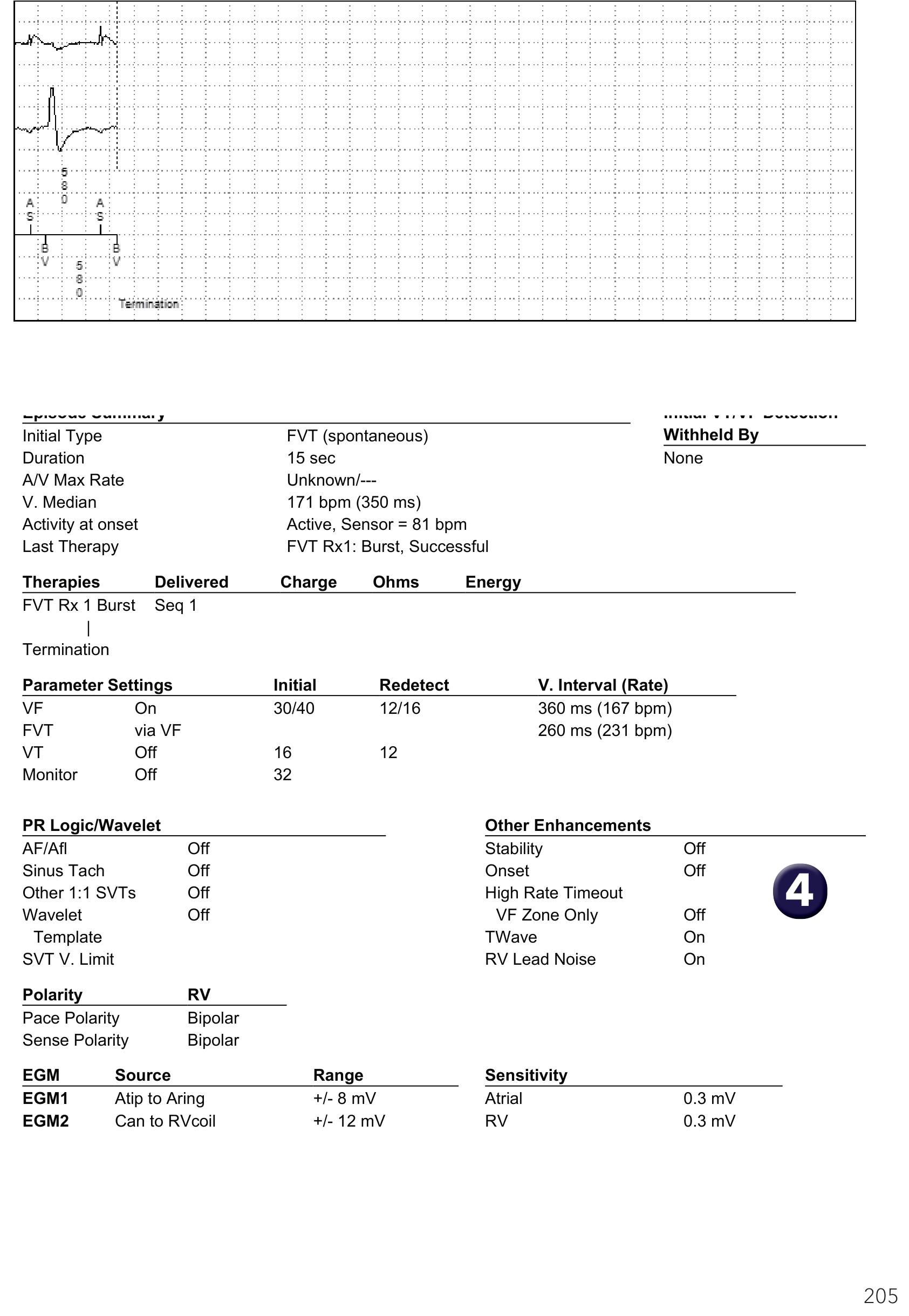 Medtronic ICD electrogram, segment 1 of 1 — Discrimination and atrioventricular conduction disorders