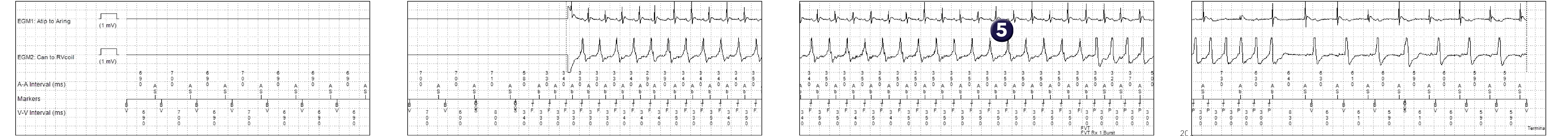 Medtronic ICD electrogram, segment 1 of 1 — Discrimination and conduction disorders