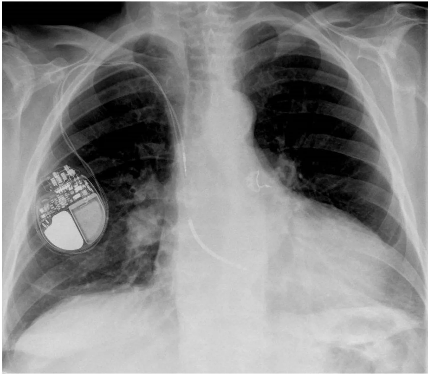 MicroPort ICD, Lead trends — Lead Parameters Evaluation (LPE) RV alert