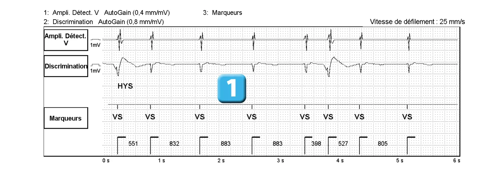 Électrogramme Abbott ICD, segment 1 sur 2 — Classification des cycles, compteurs de tachycardie et évolution des recommandations