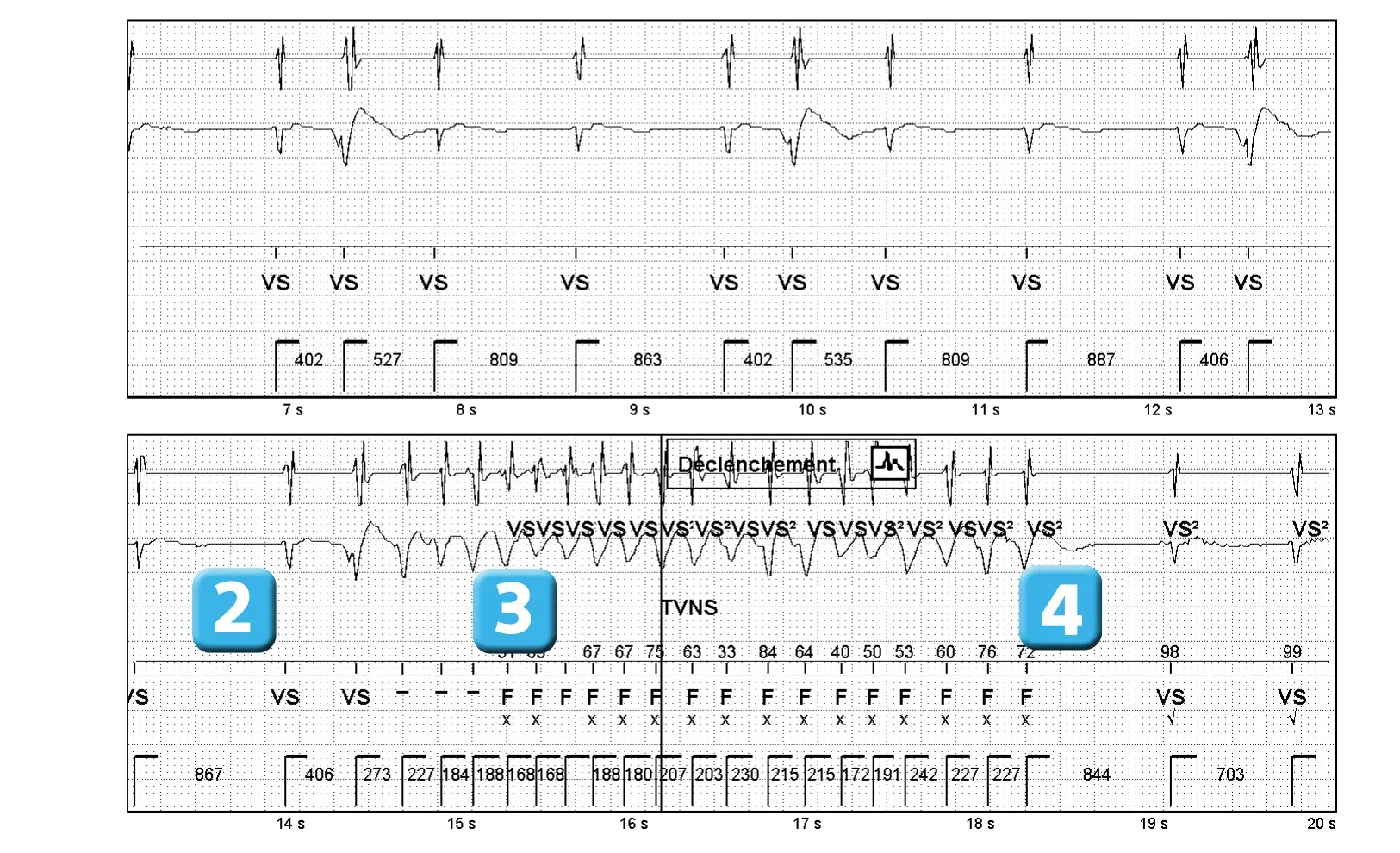Électrogramme Abbott ICD, segment 2 sur 2 — Classification des cycles, compteurs de tachycardie et évolution des recommandations