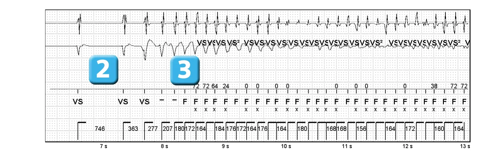 Électrogramme Abbott ICD, segment 2 sur 4 — Classification des cycles, compteurs de tachycardie et évolution des recommandations