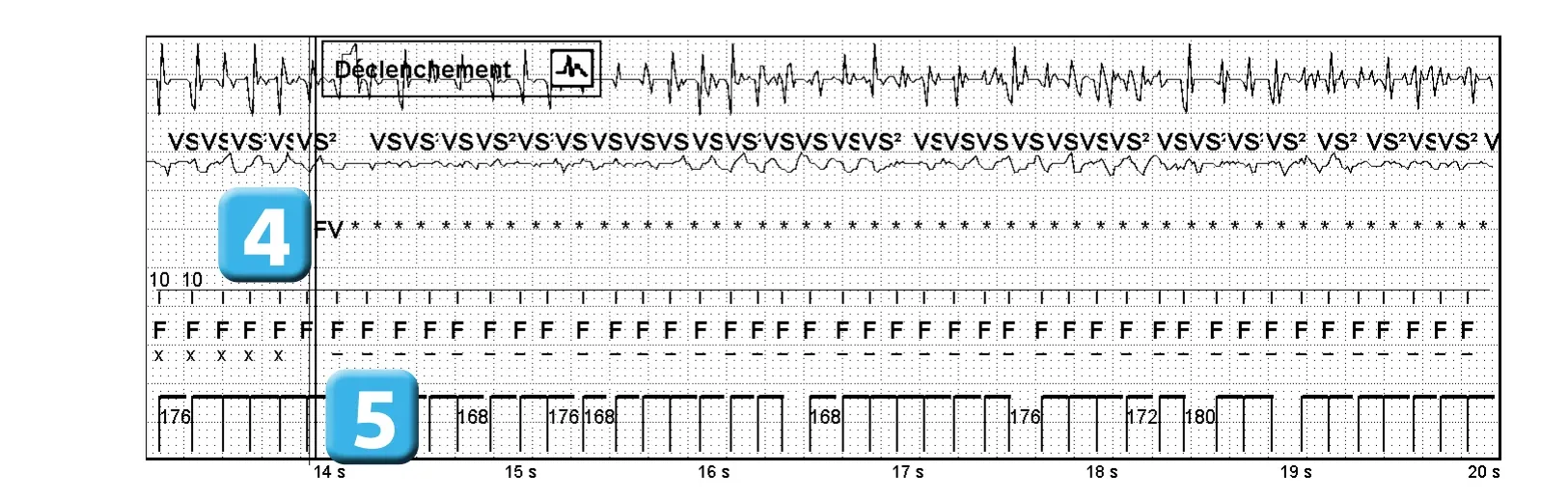 Électrogramme Abbott ICD, segment 3 sur 4 — Classification des cycles, compteurs de tachycardie et évolution des recommandations