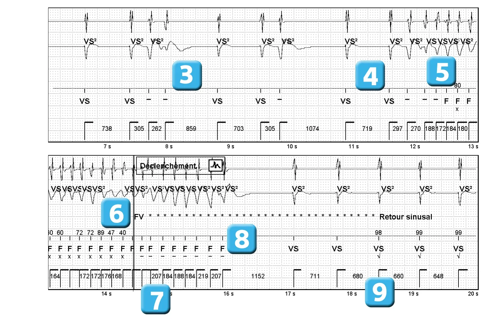 Électrogramme Abbott ICD, segment 2 sur 2 — Classification des cycles, compteurs de tachycardie et évolution des recommandations