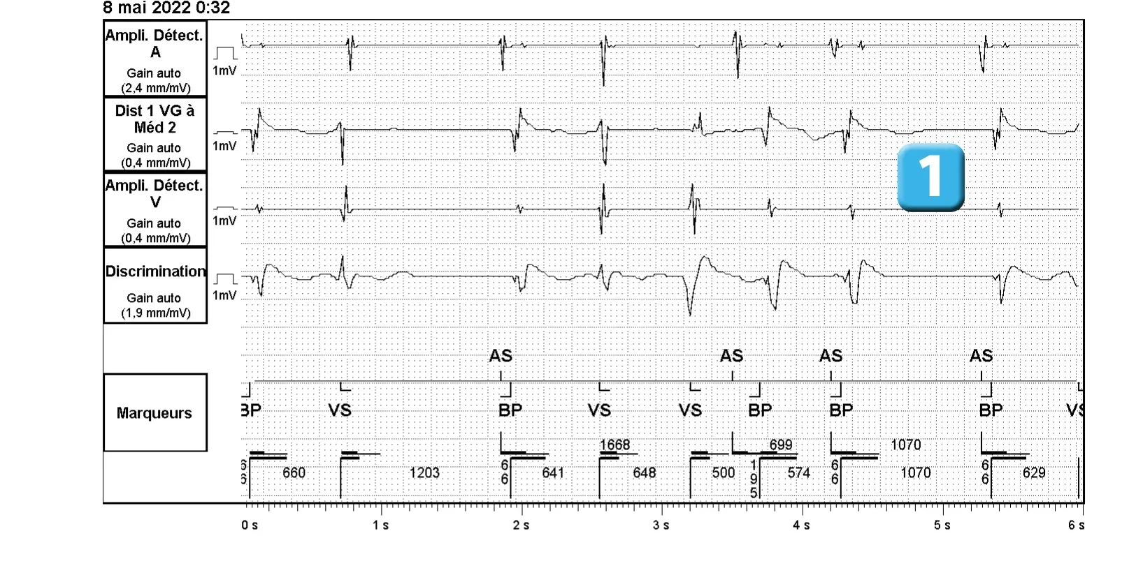 Électrogramme Abbott ICD, segment 1 sur 2 — Bases de fonctionnement, spécificités de la plateforme Gallant