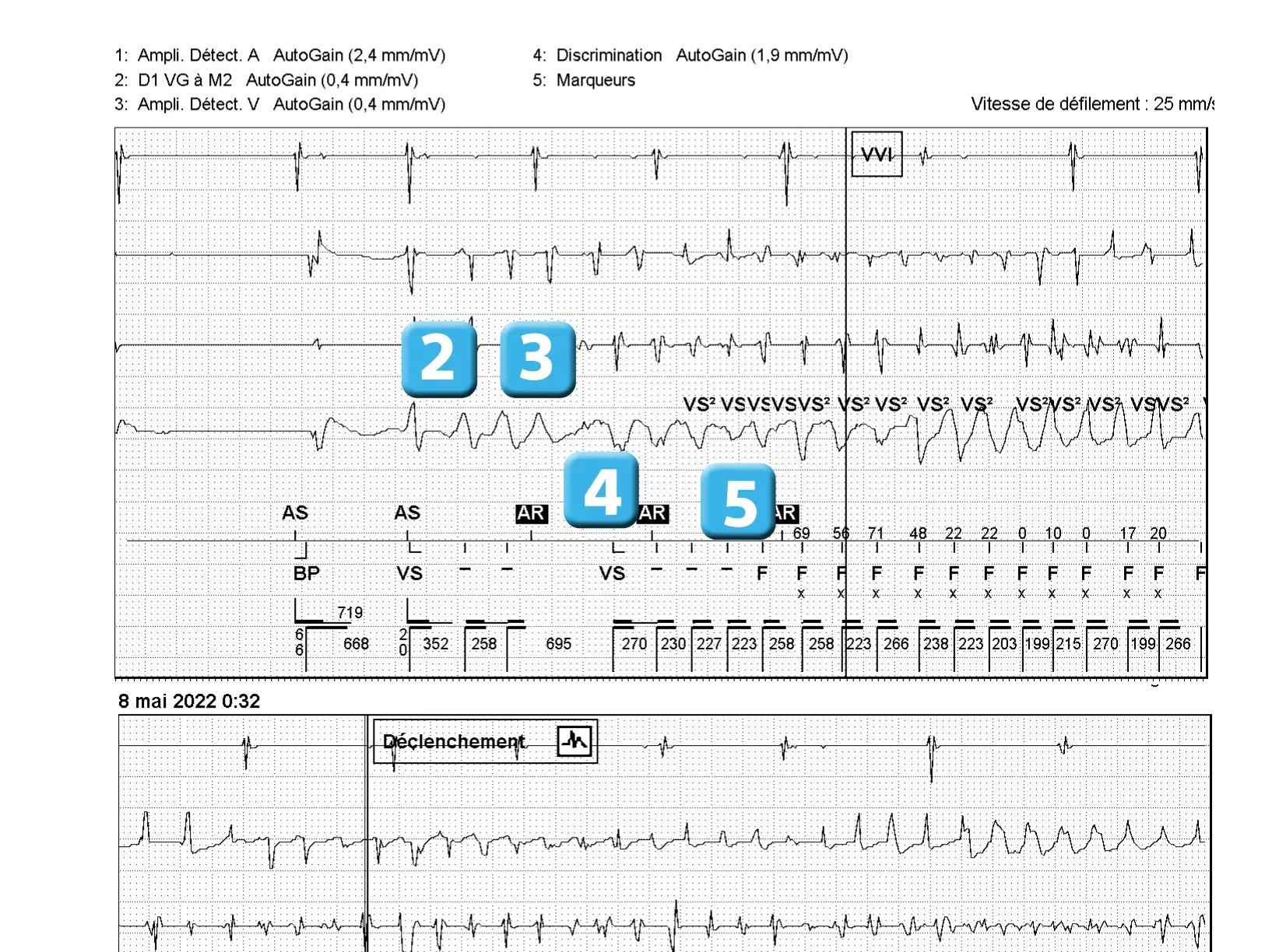 Électrogramme Abbott ICD, segment 2 sur 2 — Bases de fonctionnement, spécificités de la plateforme Gallant