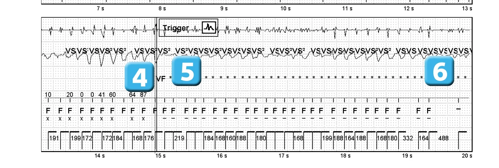 Électrogramme Abbott ICD, segment 2 sur 4 — Bases de fonctionnement, détection initiale et redétection