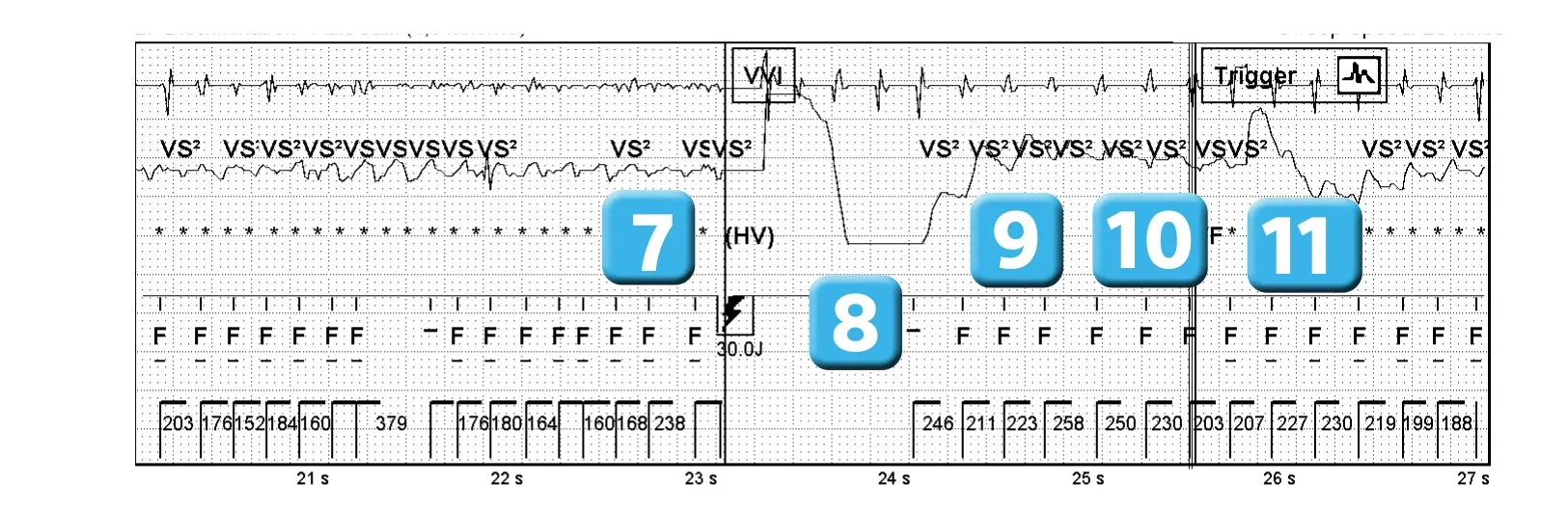 Électrogramme Abbott ICD, segment 3 sur 4 — Bases de fonctionnement, détection initiale et redétection
