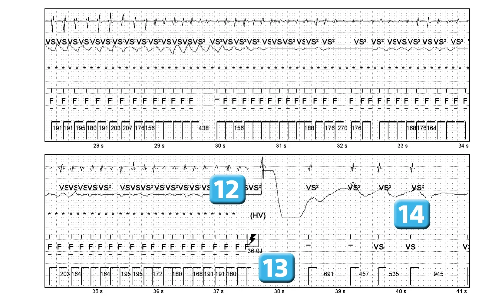 Électrogramme Abbott ICD, segment 4 sur 4 — Bases de fonctionnement, détection initiale et redétection