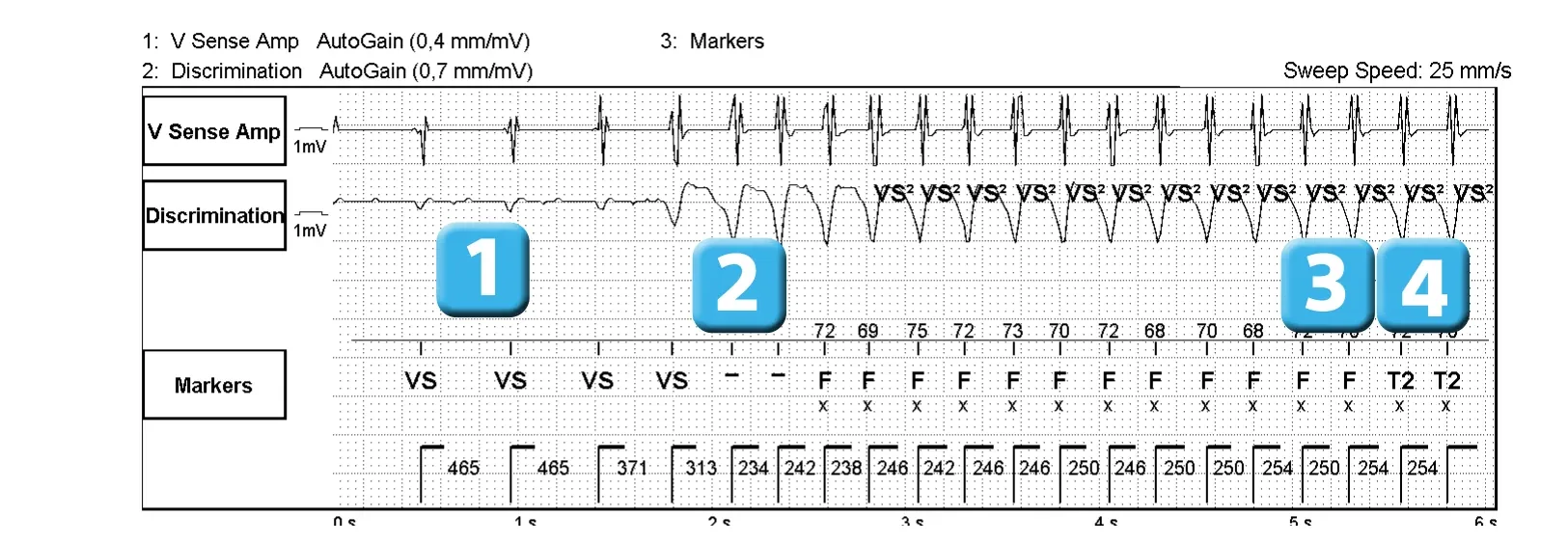 Électrogramme Abbott ICD, segment 1 sur 2 — Compétition entre les différents compteurs de détection