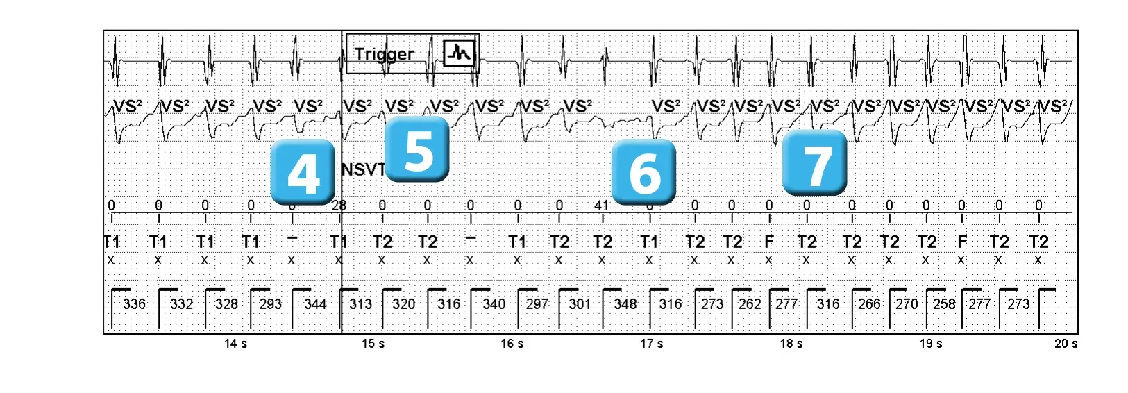 Électrogramme Abbott ICD, segment 3 sur 3 — Compétition entre les différents compteurs de détection et réduction spontanée