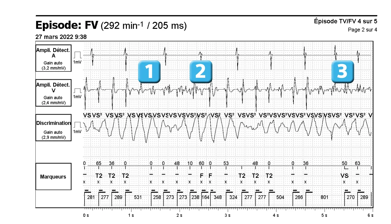 Électrogramme Abbott ICD, segment 1 sur 3 — Classification des cycles et sous-détection ventriculaire lors d’un épisode de FV