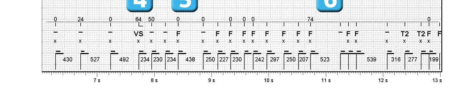 Électrogramme Abbott ICD, segment 2 sur 3 — Classification des cycles et sous-détection ventriculaire lors d’un épisode de FV