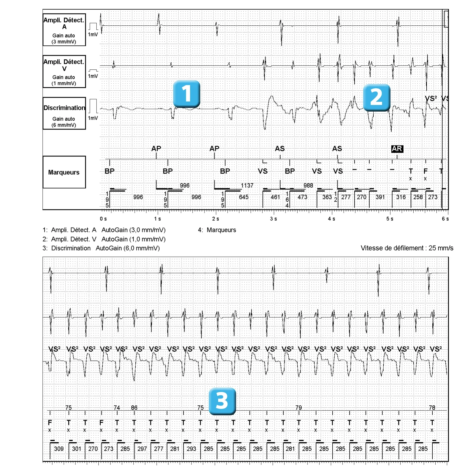 Électrogramme Abbott ICD, segment 1 sur 5 — Compteur de redétection après accélération d’une TV en zone de FV