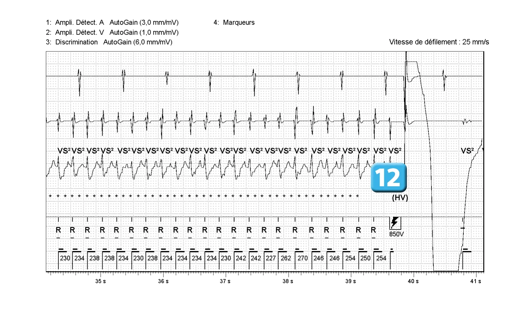 Électrogramme Abbott ICD, segment 4 sur 5 — Compteur de redétection après accélération d’une TV en zone de FV