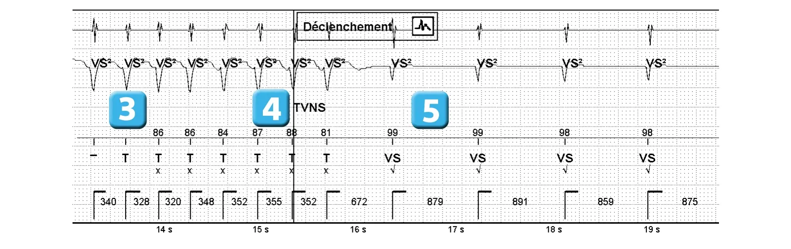 Électrogramme Abbott ICD, segment 1 sur 1 — Nouvelles recommandations et nombre de cycles en détection initiale