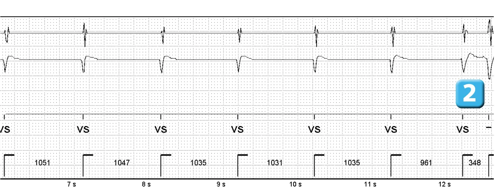 Électrogramme Abbott ICD, segment 2 sur 3 — Nouvelles recommandations et nombre de cycles en détection initiale