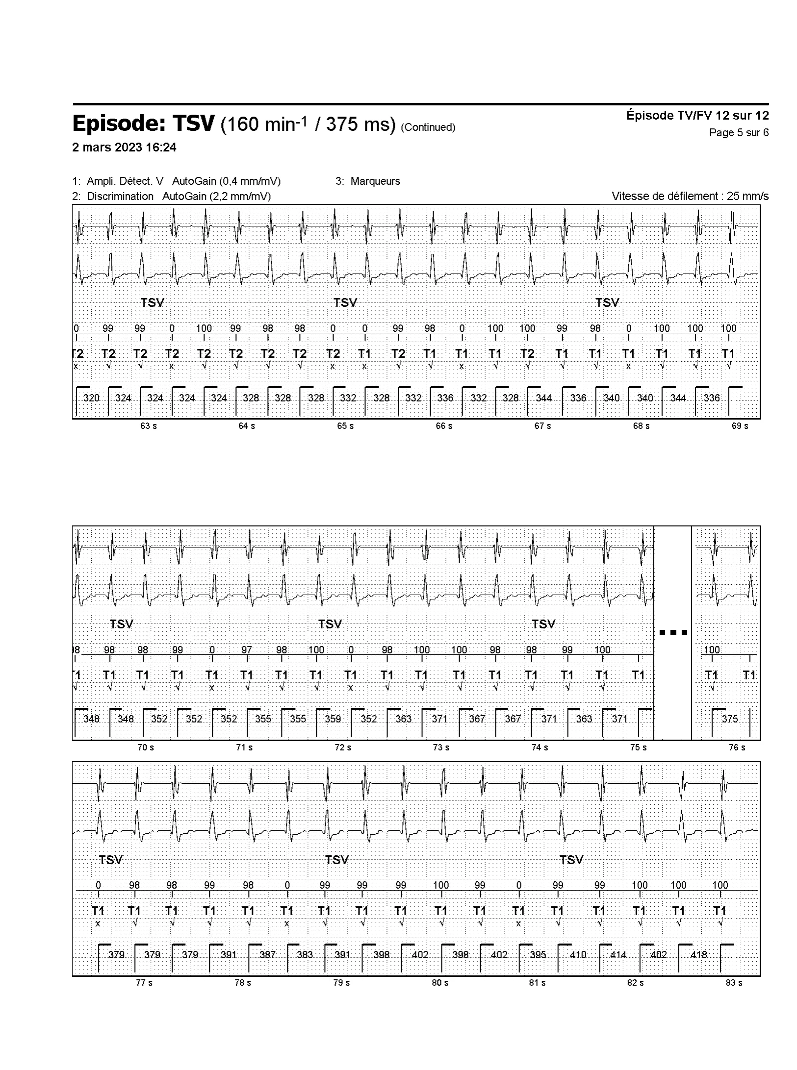 Episode de tachycardie sinusale et discrimination simple chambre
