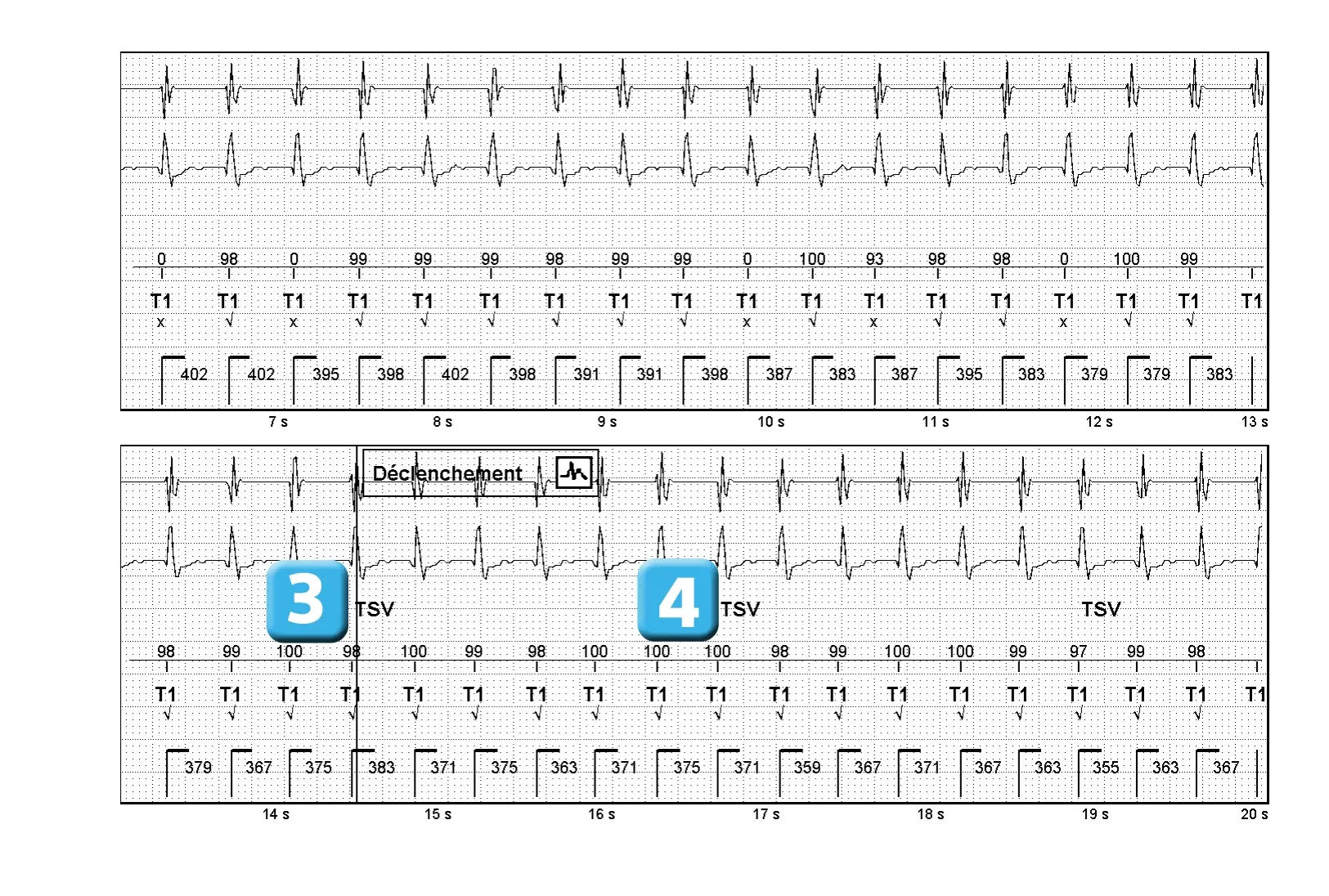 Électrogramme Abbott ICD, segment 2 sur 4 — Episode de tachycardie sinusale et discrimination simple chambre