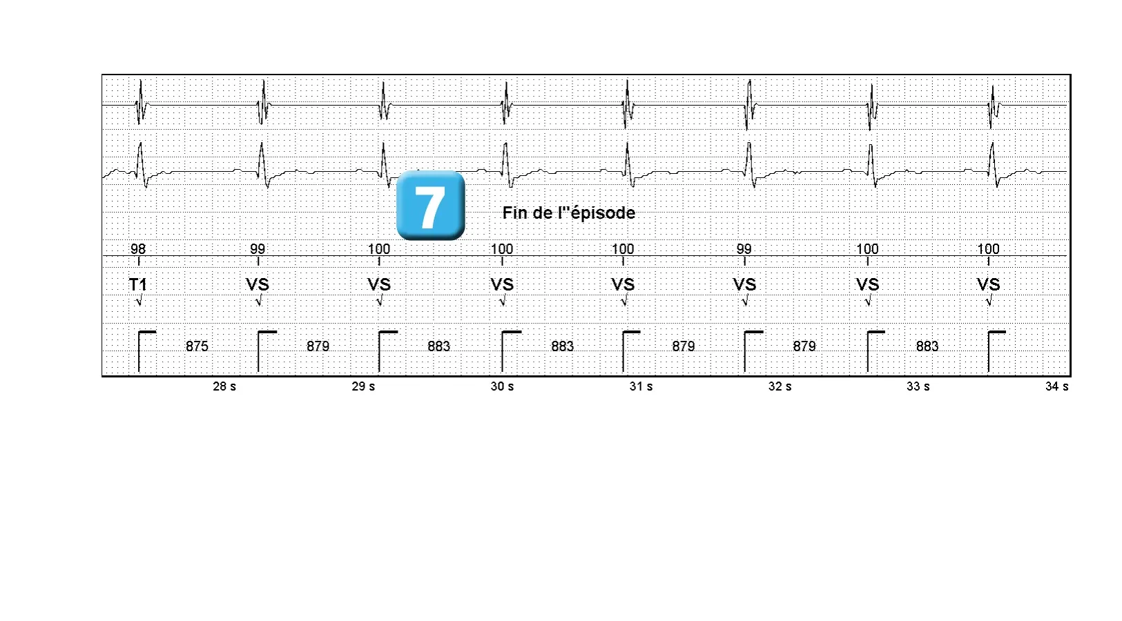 Électrogramme Abbott ICD, segment 3 sur 3 — Tachycardie atriale et discrimination simple chambre