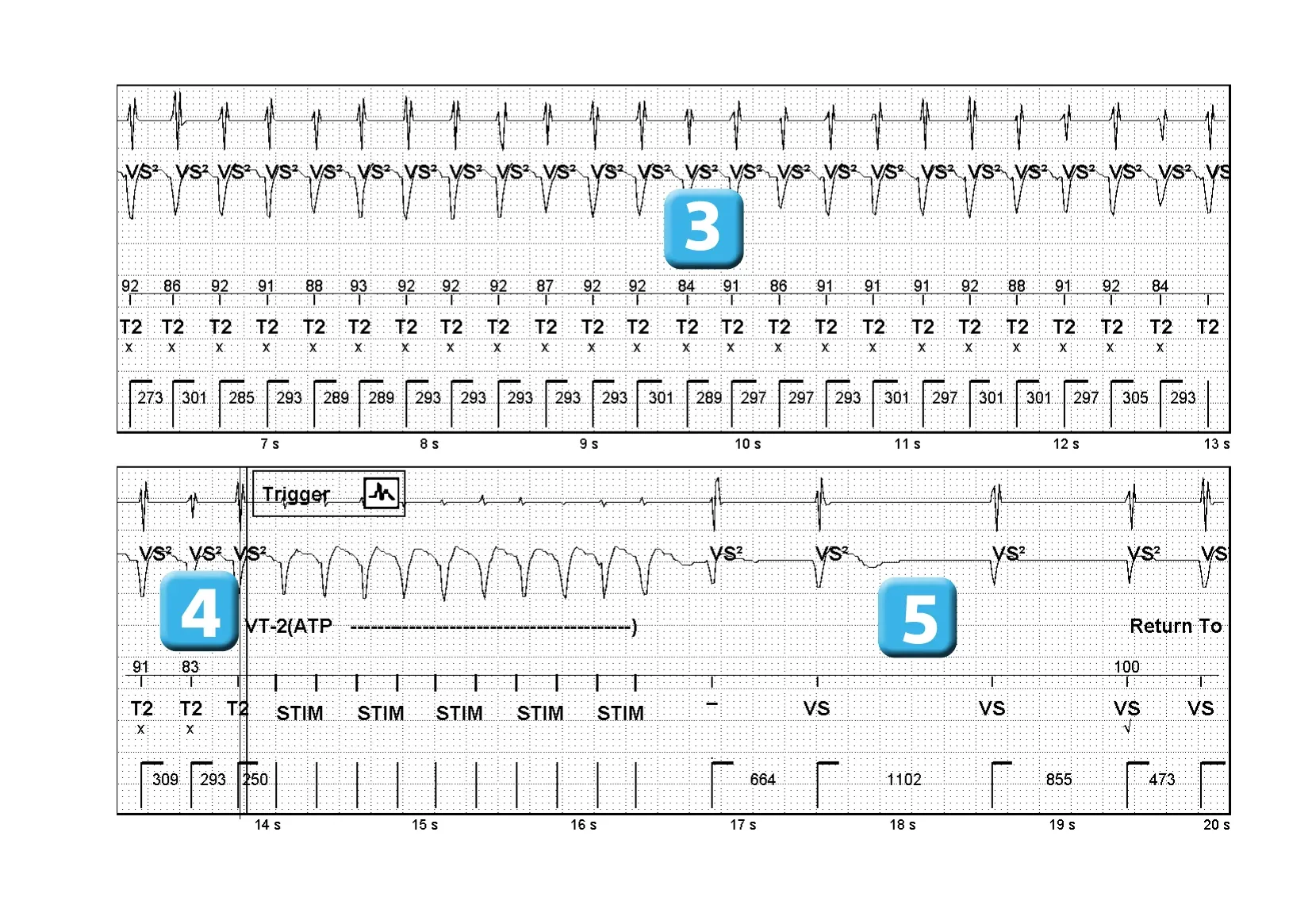 Électrogramme Abbott ICD, segment 2 sur 2 — Discrimination simple chambre et optimisation du critère basé sur la morphologie