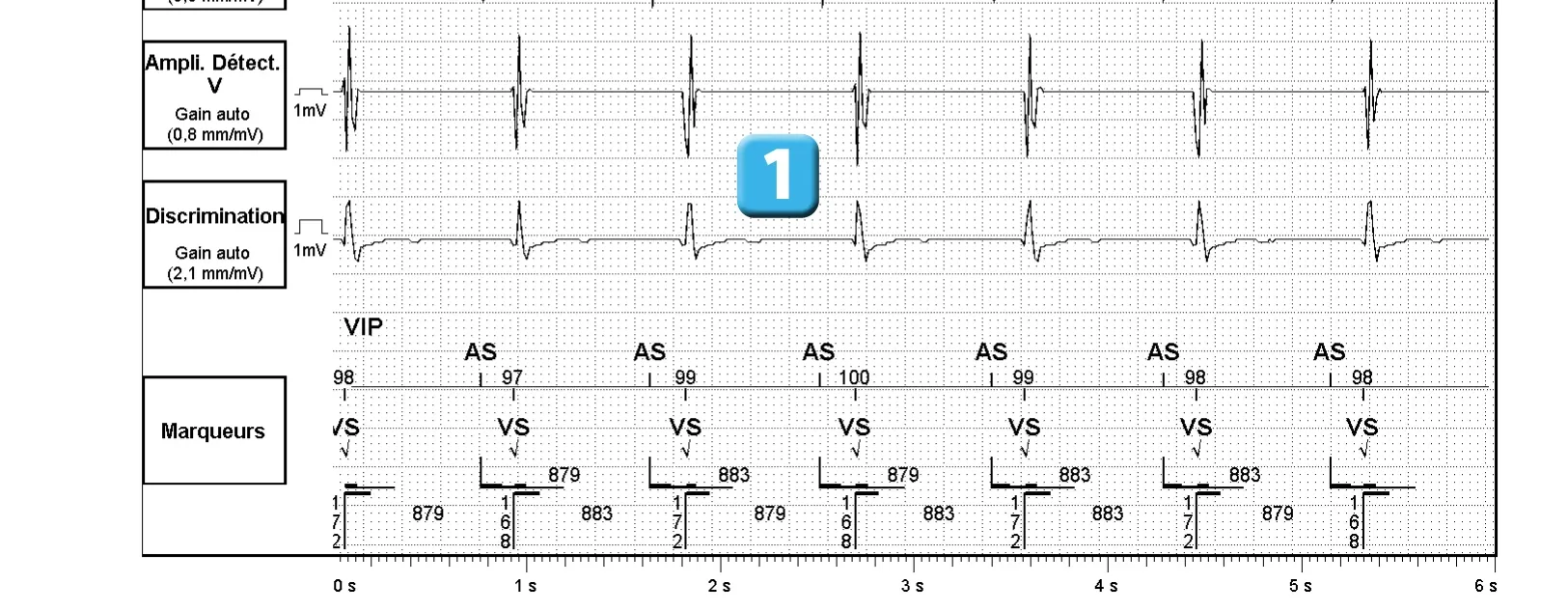 Électrogramme Abbott ICD, segment 1 sur 4 — Discrimination double chambre et branche V = A