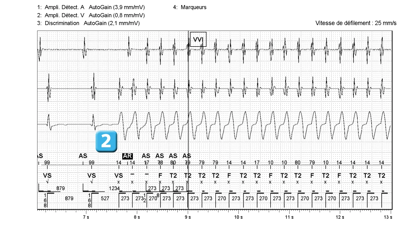 Électrogramme Abbott ICD, segment 2 sur 4 — Discrimination double chambre et branche V = A