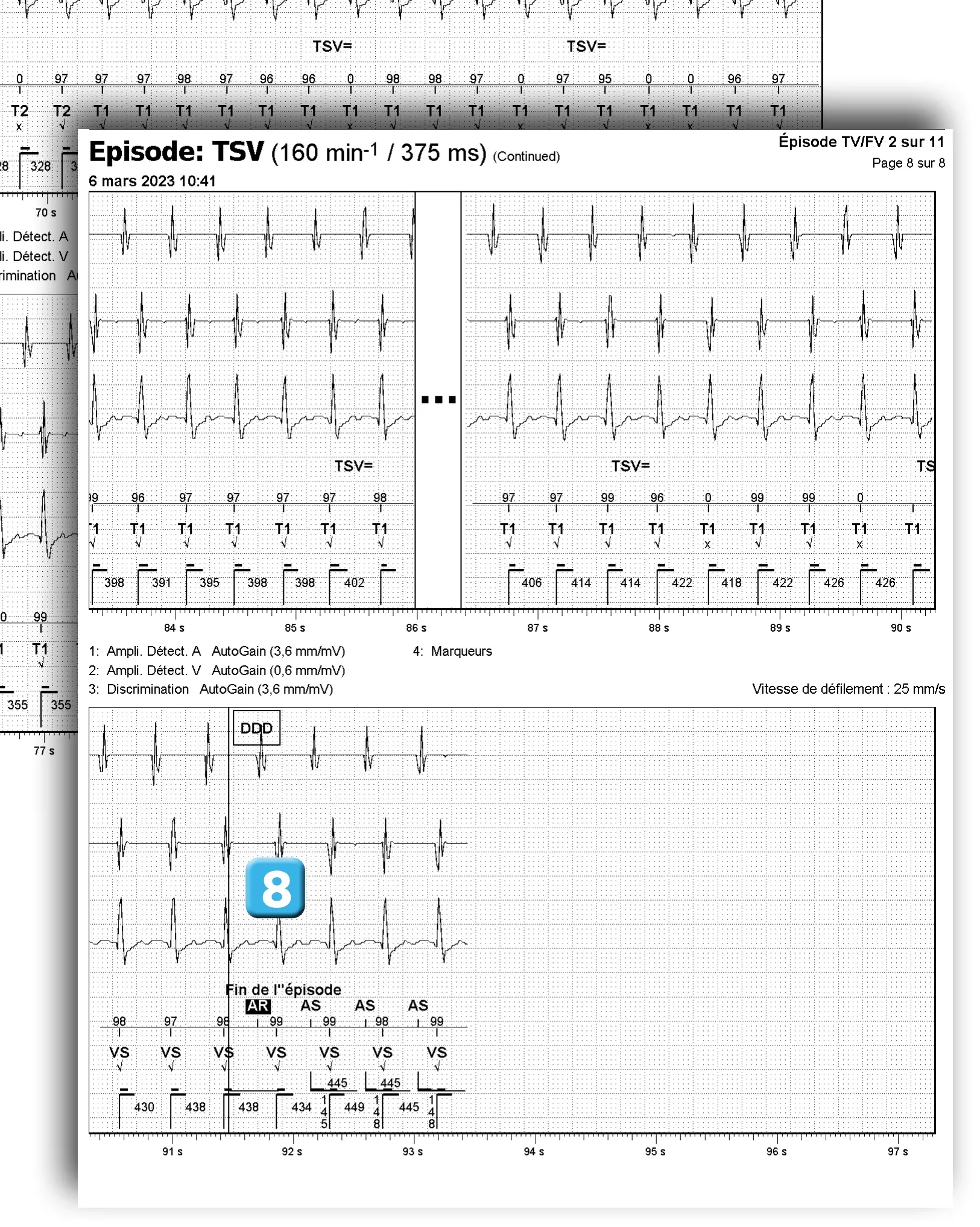 Électrogramme Abbott ICD, segment 1 sur 3 — Discrimination double chambre et branche V = A