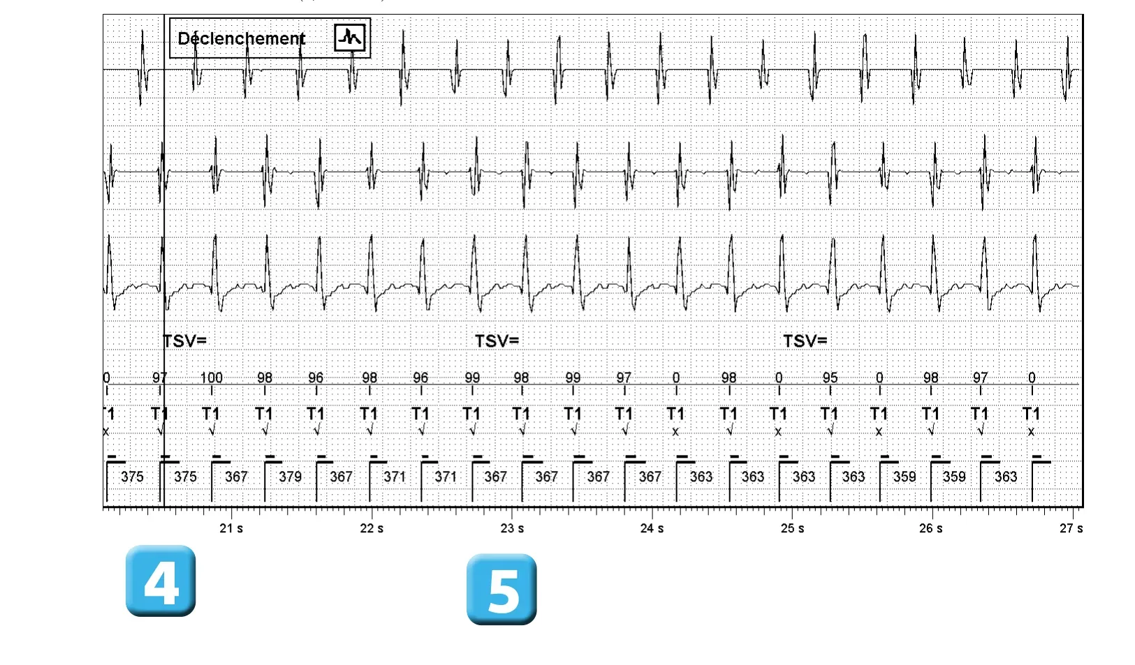 Électrogramme Abbott ICD, segment 2 sur 4 — Discrimination double chambre et branche V = A