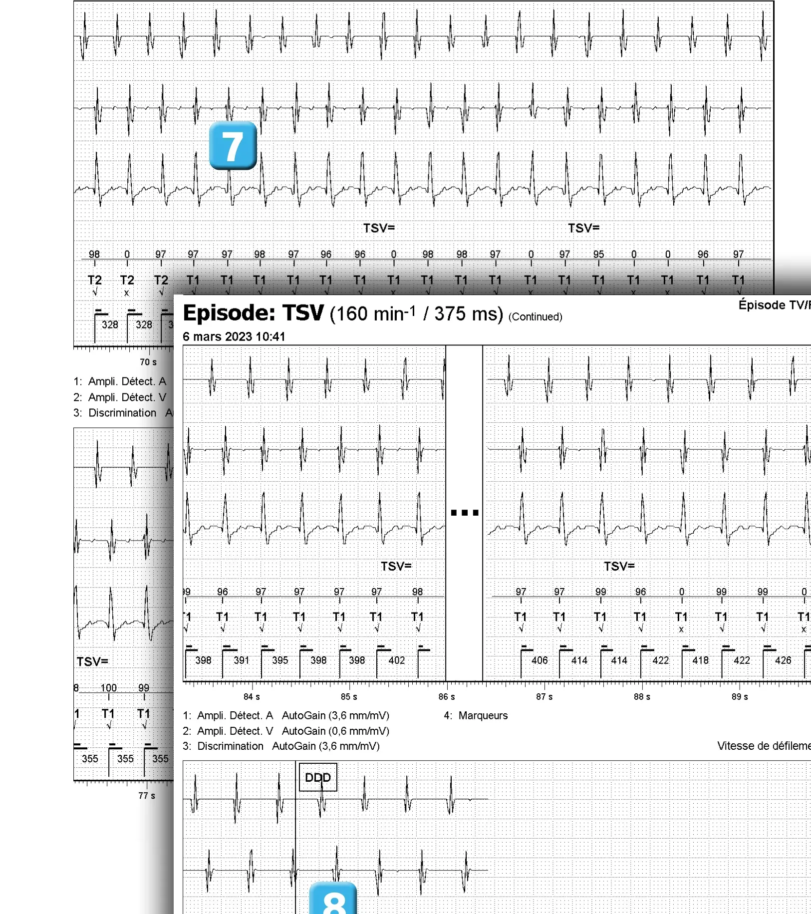 Électrogramme Abbott ICD, segment 4 sur 4 — Discrimination double chambre et branche V = A