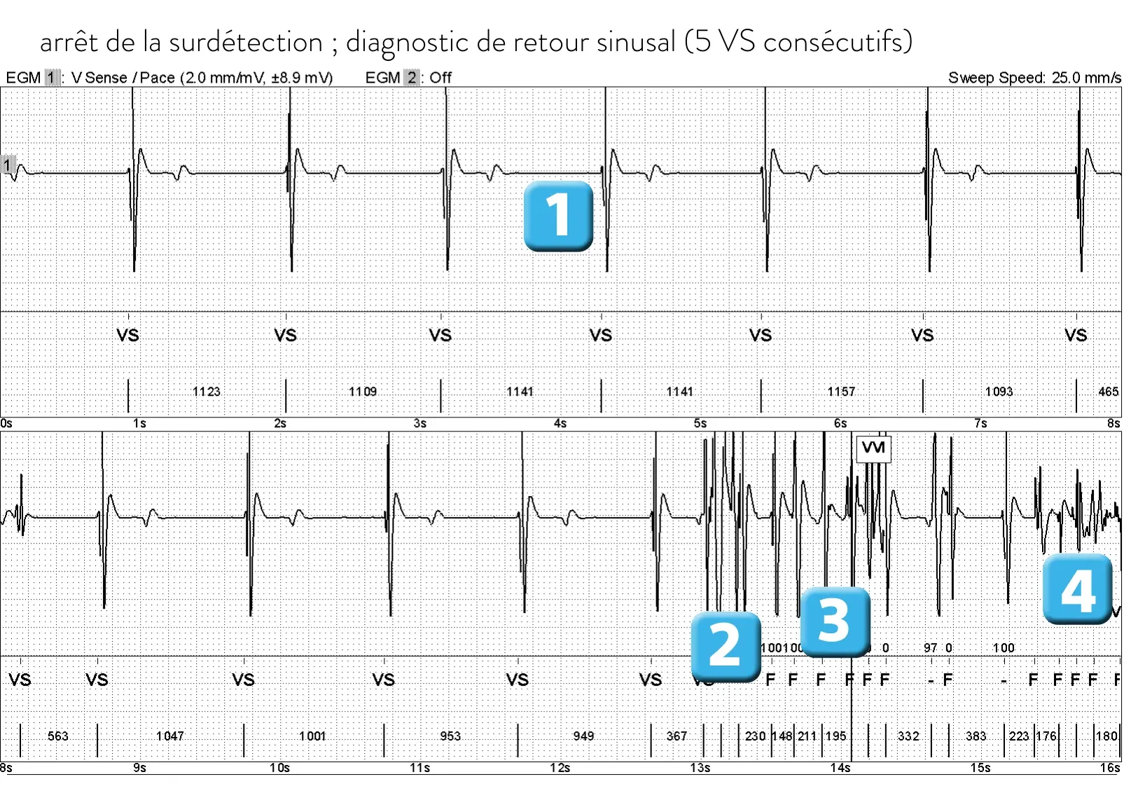 Électrogramme Abbott ICD, segment 1 sur 2 — Rupture de sonde sur un modèle ancien