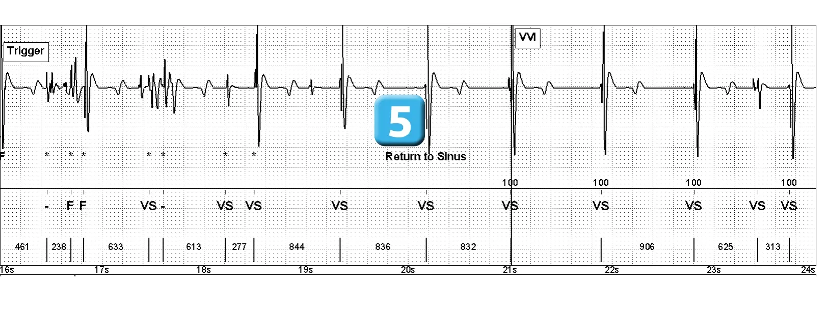 Électrogramme Abbott ICD, segment 2 sur 2 — Rupture de sonde sur un modèle ancien