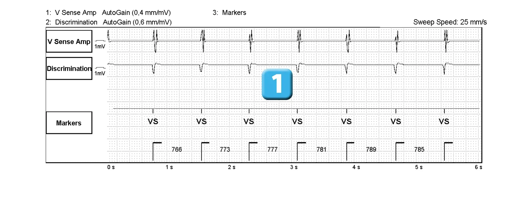 Électrogramme Abbott ICD, segment 1 sur 2 — Surdétection d’un signal 50 Hz