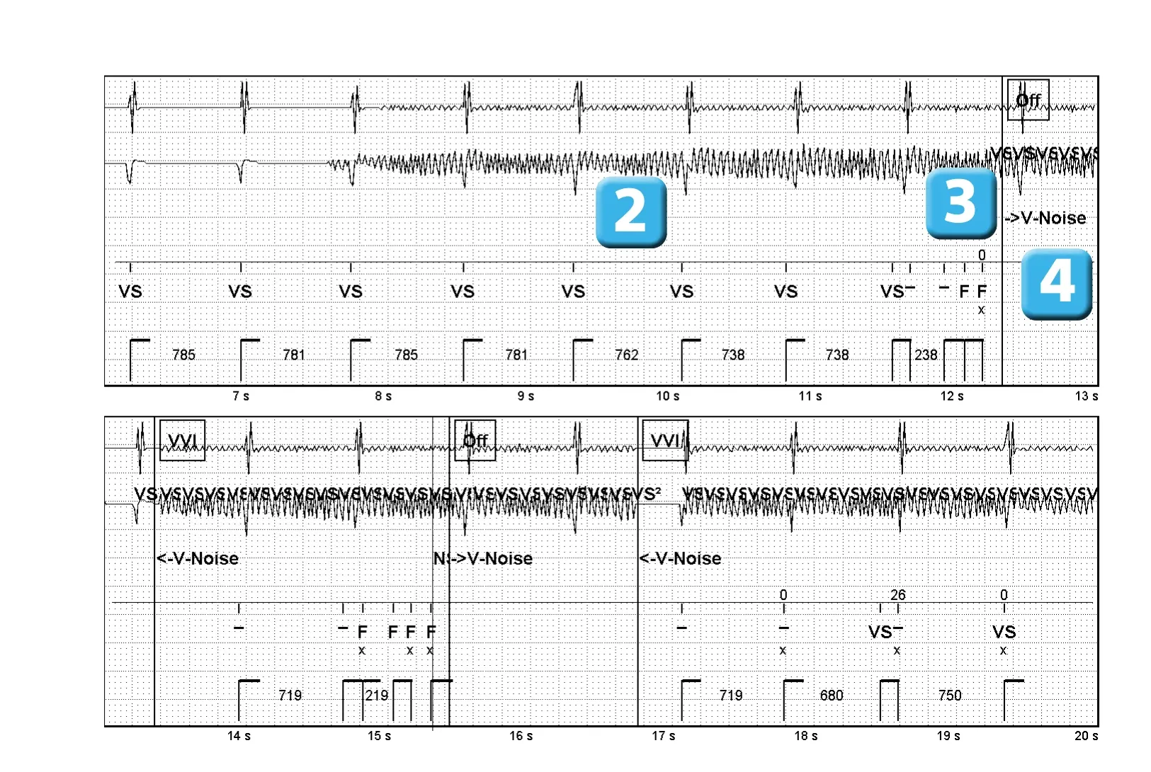 Électrogramme Abbott ICD, segment 2 sur 2 — Surdétection d’un signal 50 Hz