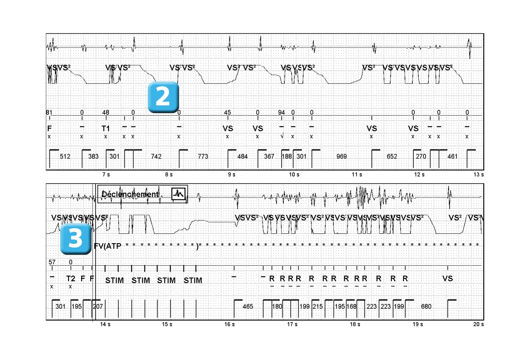 Électrogramme Abbott ICD, segment 2 sur 2 — Chirurgie et utilisation du bistouri électrique
