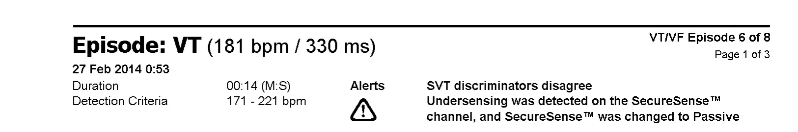 Électrogramme Abbott ICD, segment 1 sur 2 — Algorithme SecureSense™ et sous-détection sur le canal de discrimination