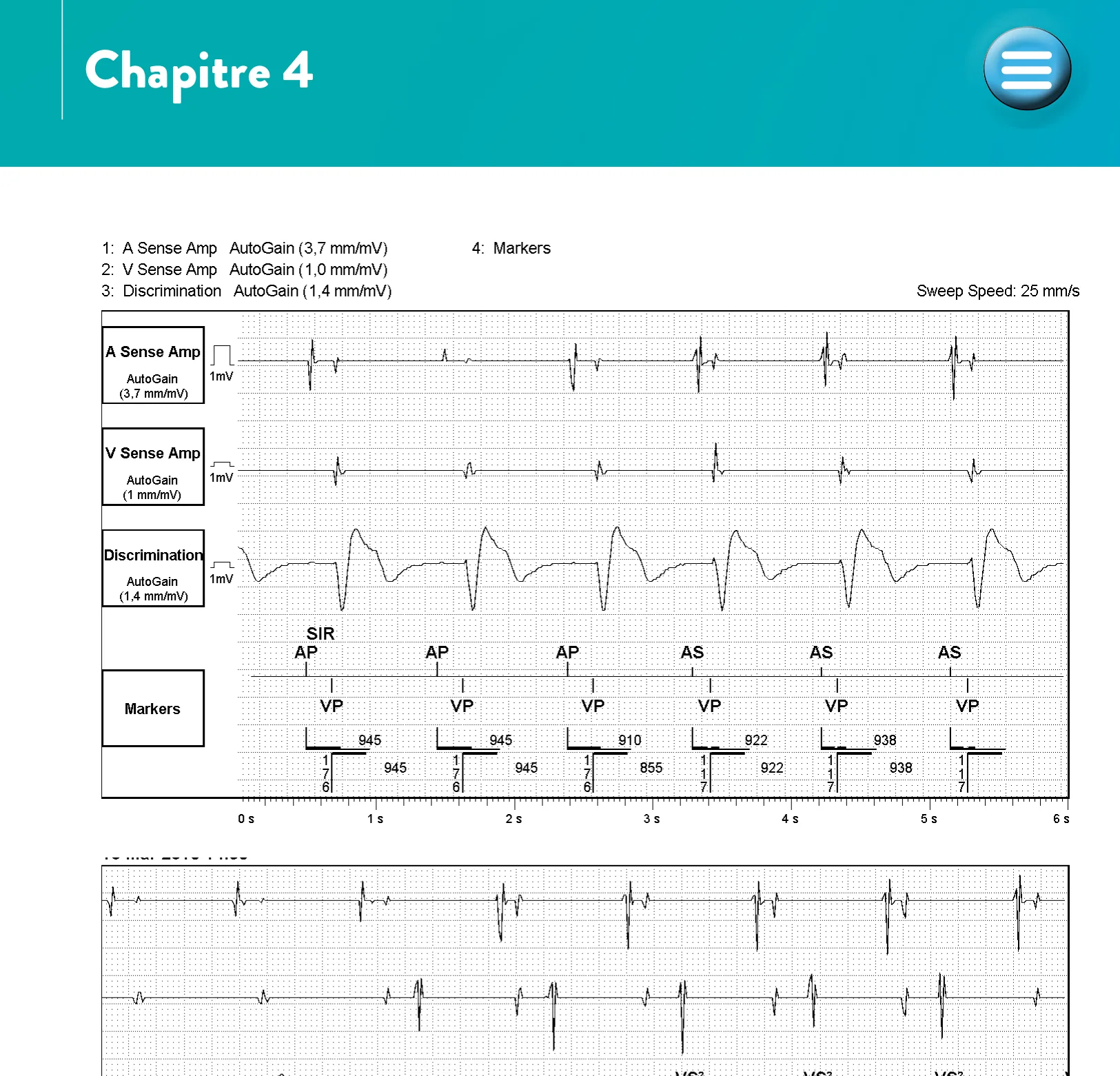 Algorithme SecureSense™ et perte de capture ventriculaire droite