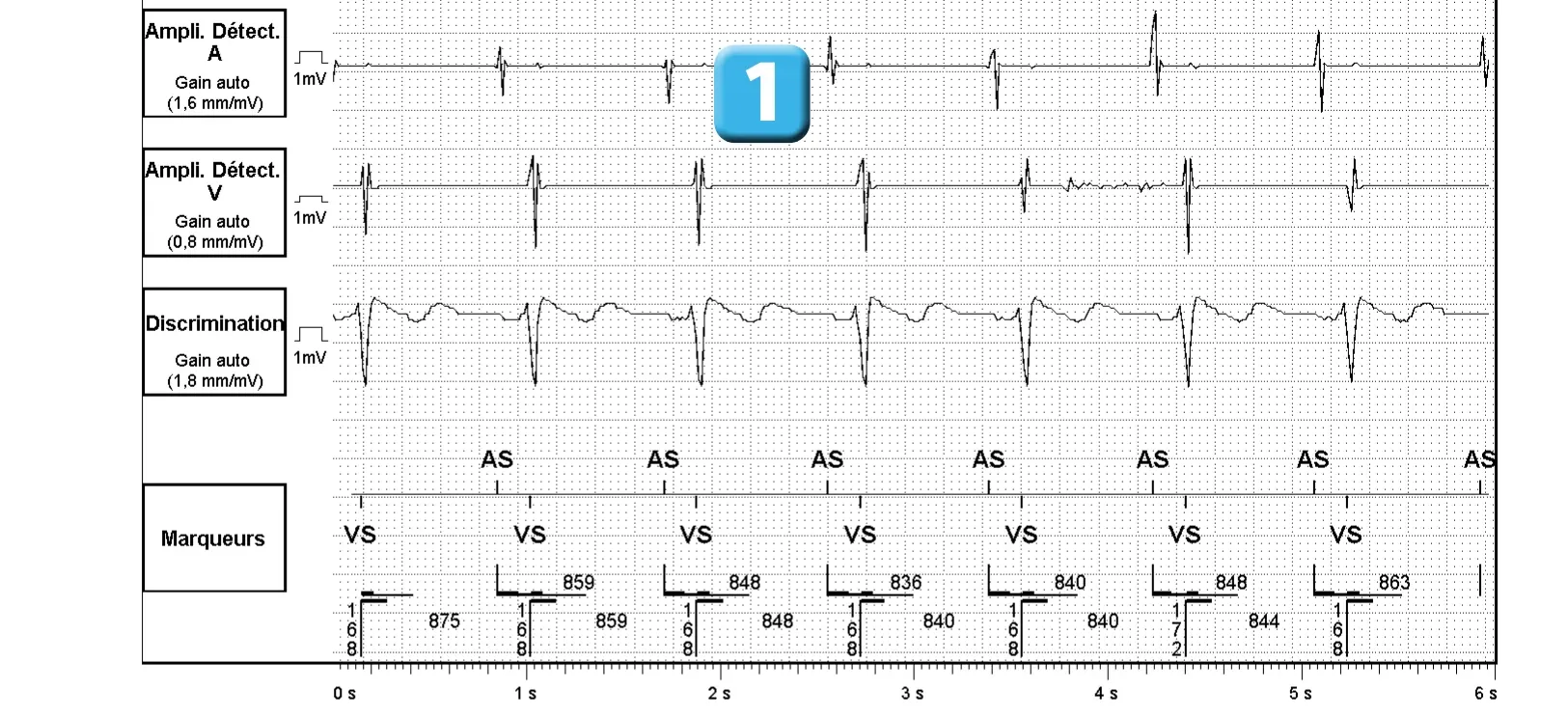 Électrogramme Abbott ICD, segment 1 sur 3 — Dispositif récent, dysfonction de sonde et algorithme SecureSense™