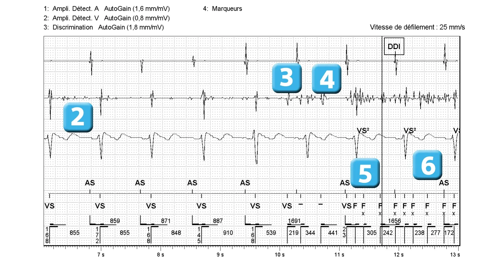 Électrogramme Abbott ICD, segment 2 sur 3 — Dispositif récent, dysfonction de sonde et algorithme SecureSense™