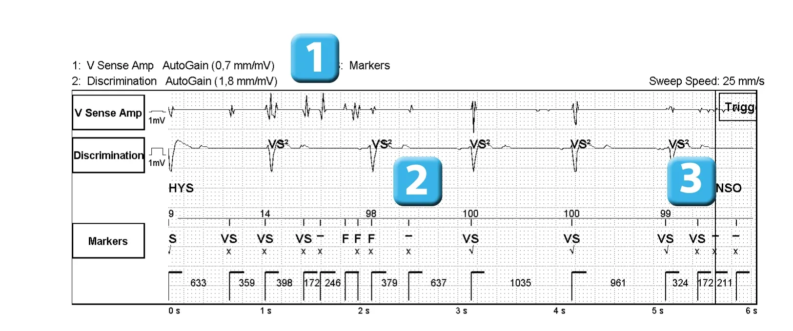 Électrogramme Abbott ICD, segment 2 sur 3 — Dispositif récent, dysfonction de sonde et algorithme SecureSense™