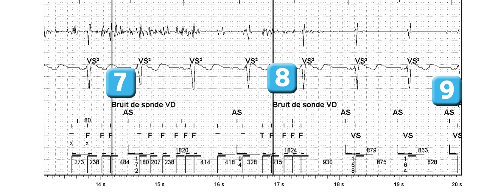 Électrogramme Abbott ICD, segment 3 sur 3 — Dispositif récent, dysfonction de sonde et algorithme SecureSense™