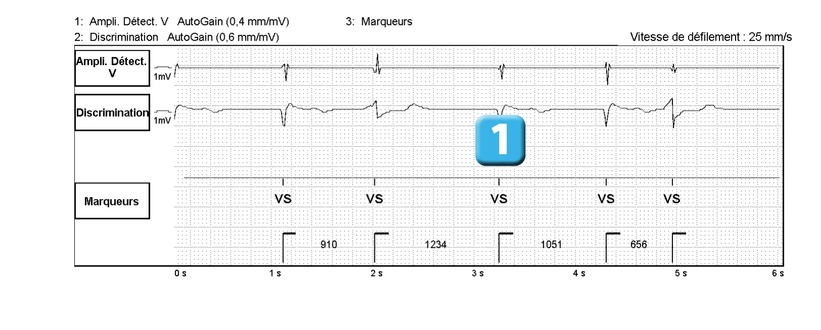 Électrogramme Abbott ICD, segment 1 sur 2 — Dysfonction de sonde révélée par un choc électrique
