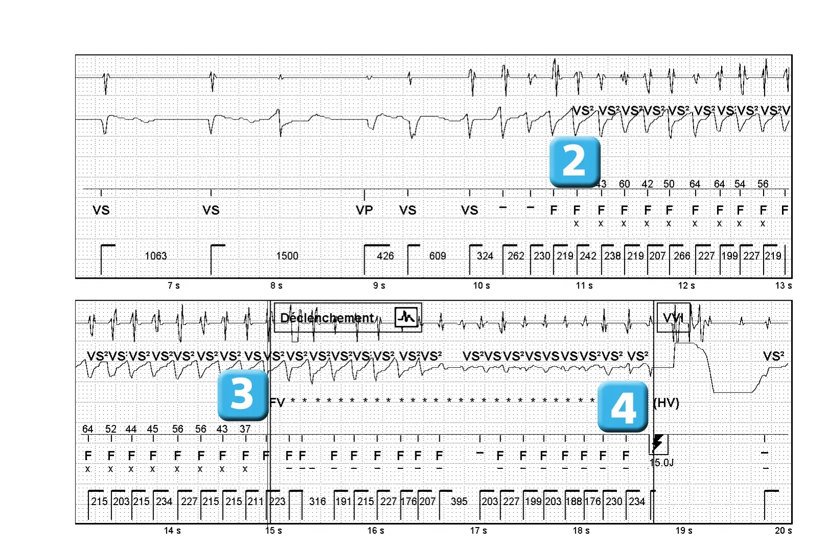 Électrogramme Abbott ICD, segment 2 sur 2 — Dysfonction de sonde révélée par un choc électrique